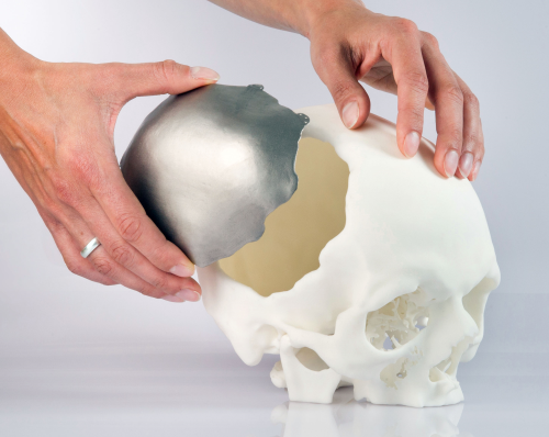 The Slovakian company, CEIT Biomedical Engineering, is using an EOS metal additive manufacturing system, the EOSINT M 280, to produce bespoke and standard implants layer-by-layer from Ti-6Al-4V powder.