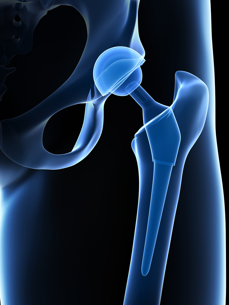 The 3D printed tantalum powder could be used for bespoke biomedical applications such as hip joints.