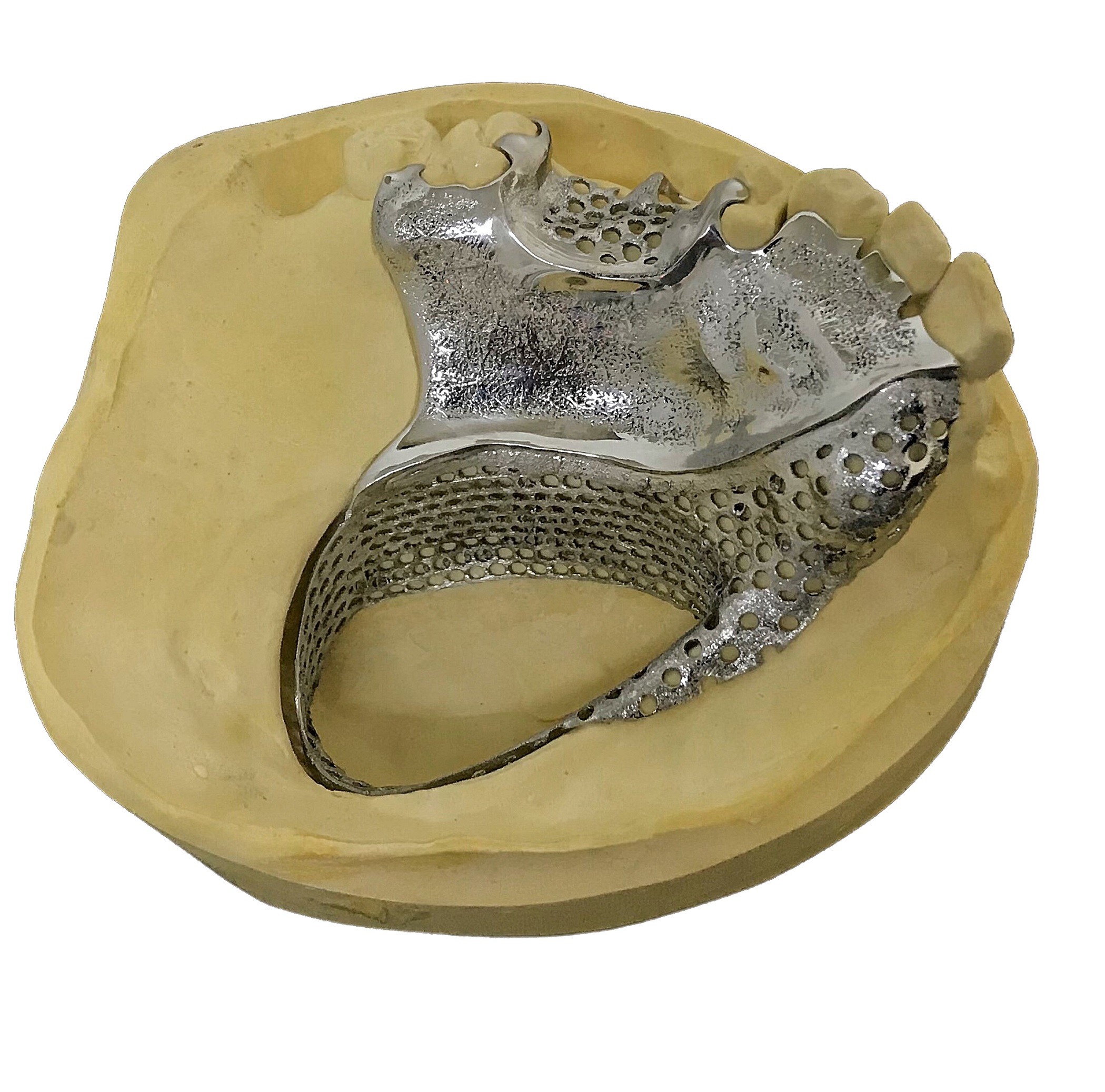 Removable partial denture incorporating a palatal obturator. (Design by Gill Egan.)