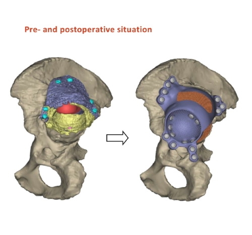 The pre and postoperative hip. The titanium implant is shown in purple.