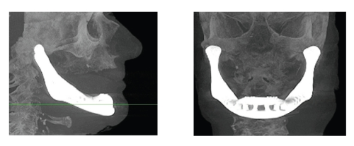 X-ray images showing the AM-produced lower jaw reconstruction implanted into the patient (left: side view; right: front view).
