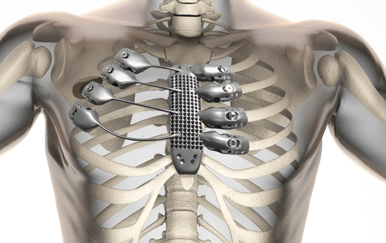 How the 3D printed sternum and rib cage was designed to fit inside the patient’s body. Photo courtesy Anatomics.